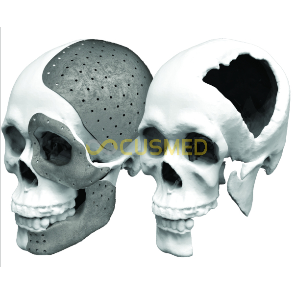 Patient Specific Implant PSI